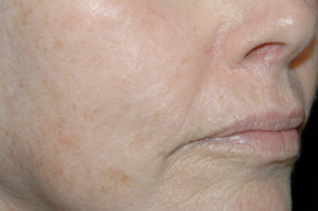 Environ Skin Care Sun Damaged Skin after