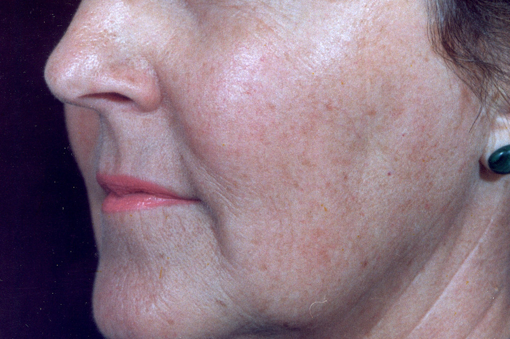 Environ Skin Care | What it can do for skin - Ageing Skin - After