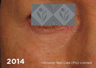 Environ Skin Care | 2014 - 19 years after using Ionzyme C-Quence Range & Ionzyme DF Machine Treatments