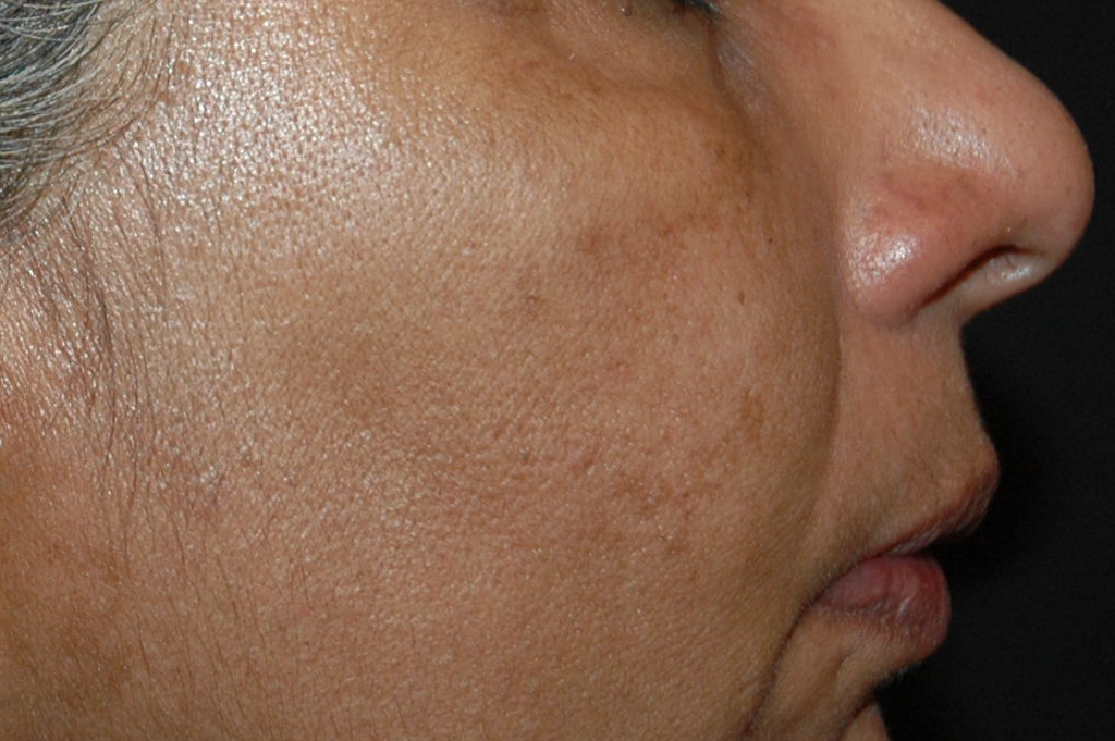40190818_pigmentation_after