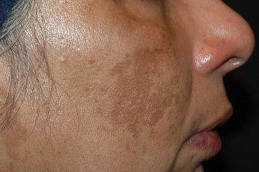 40190818_pigmentation_before