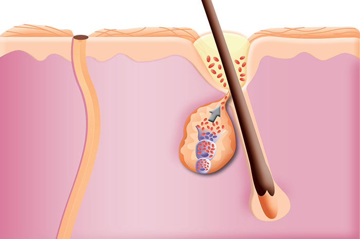 Colour image of internal view of clogged pores