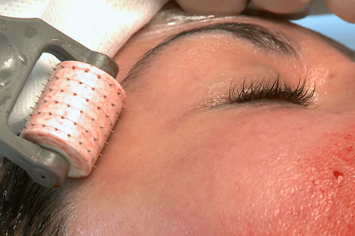 Microneedling around the eye using the Roller-CIT