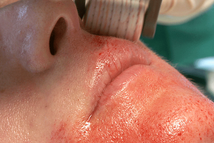 Upper lip microneedling using the Cosmetic Roll- CIT