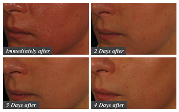 Before and after collage of 4 images of the cheek area