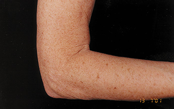 Before image of a saggy arm.