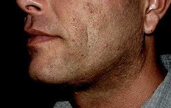Before image, cheek and chin area of a male