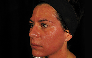 Side image of a woman's face immediately after microneedling