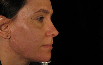 Right side image of Pamela Addison's face after treatment