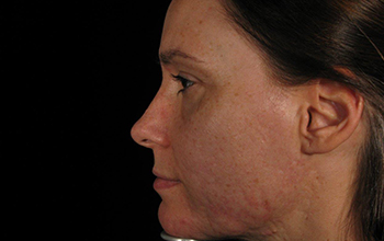 Left side image of Pamela Addison's face before treatment