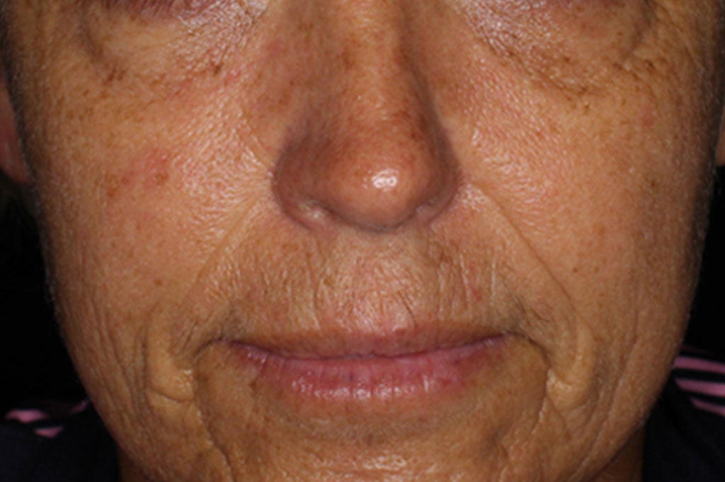 moisture boost cool peel, after