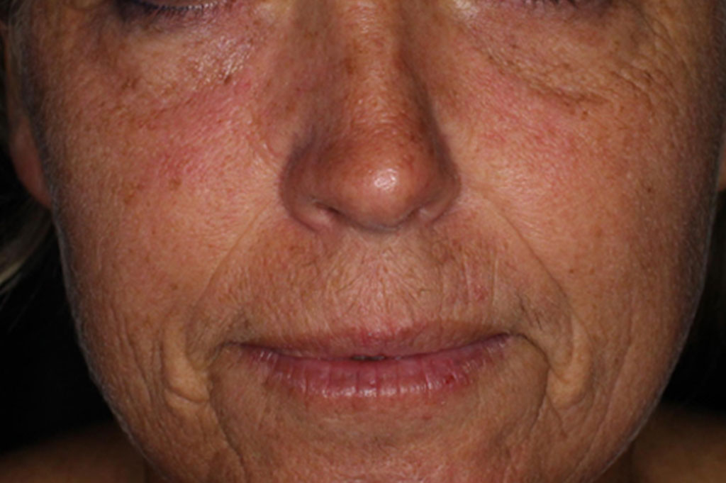 moisture boost cool peel, before