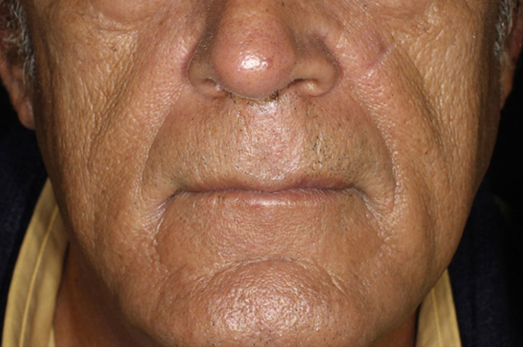 vibrant c micro peel, After.