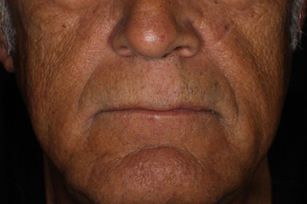 vibrant c micro peel, before.