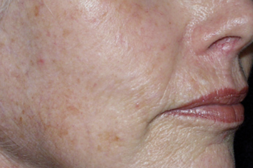Environ Skin Care Sun Damaged Skin before
