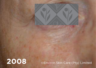 Environ Skin Care | 2008- 13 years after using Ionzyme C-Quence Range & Ionzyme DF Machine Treatments