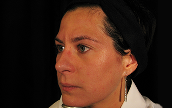 Side image of a woman's face a while after microneedling