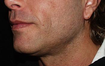 After treatment, cheek and chin area of a male