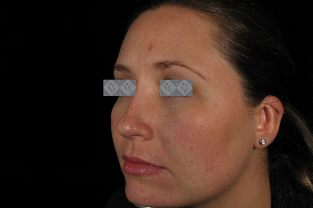 Breakouts Before & After | Environ Skin Care