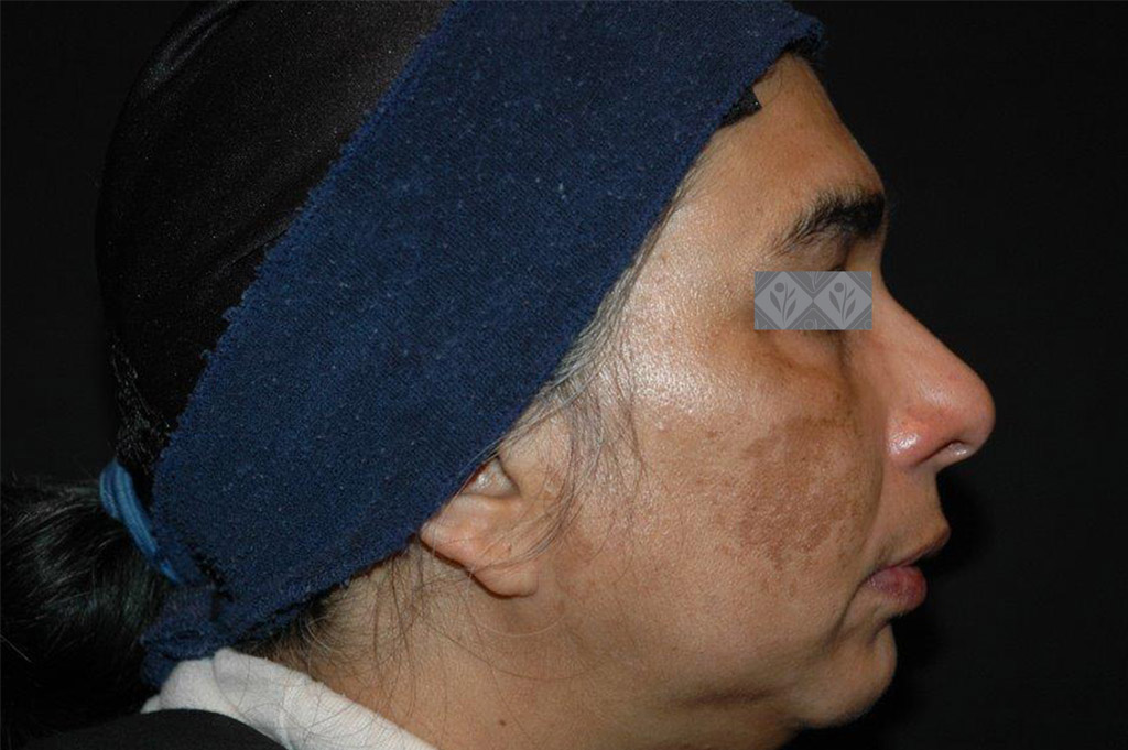Pigmentation Before & After | Environ Skin Care