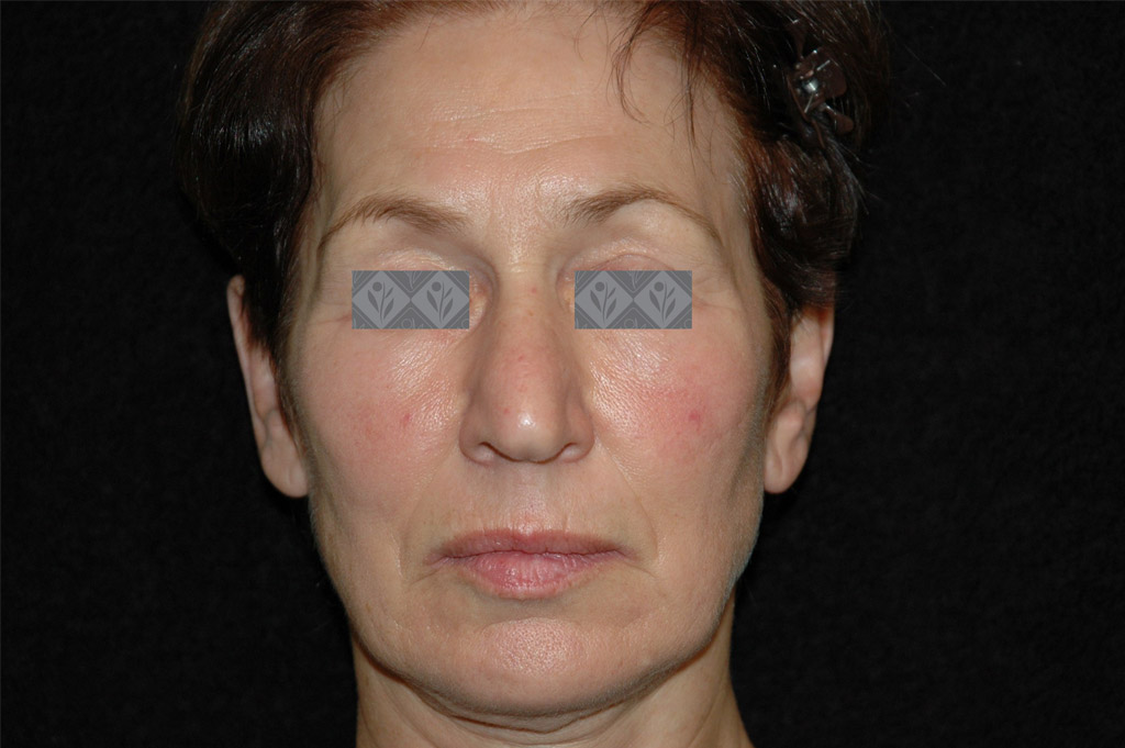 Sensitivity Before & After | Environ Skin Care