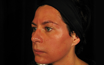 Woman with a black background after Collagen Induction treatment