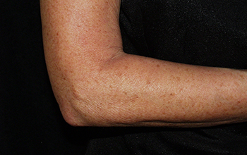 Image of a woman's arm after treatment