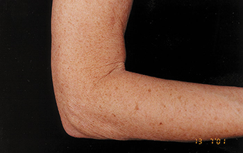 Image of a woman's arm before treatment