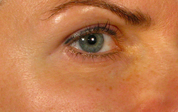 Image of a woman's eye area after treatment