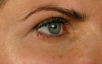 Image of a woman's eye area before treatment
