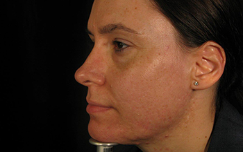 Left side image of Pamela Addison's face after treatment