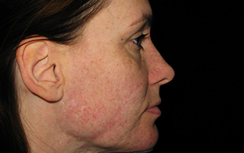 Right side image of Pamela Addison's face before treatment